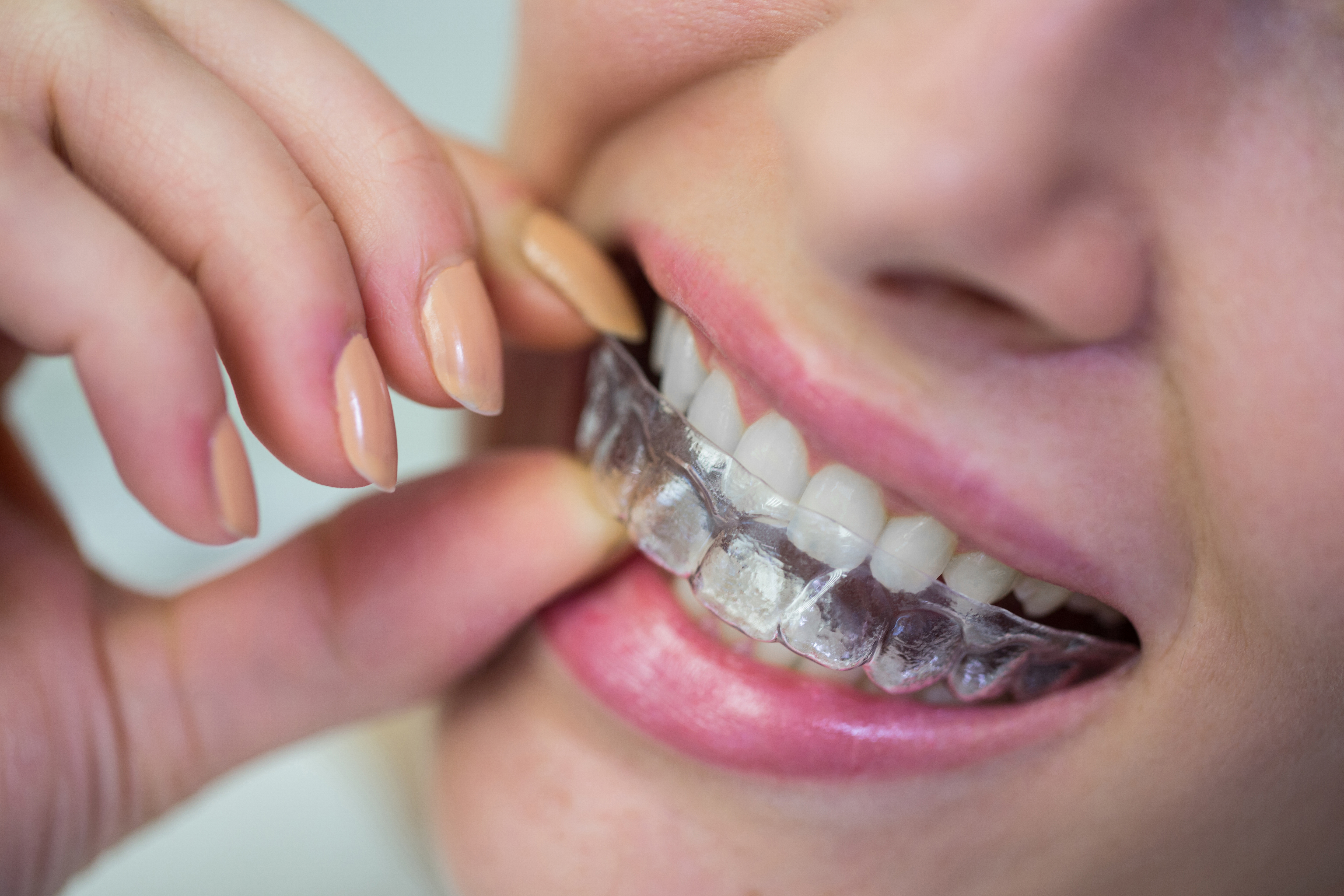 Clear Aligners / Invisible Braces