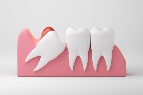 Wisdom Teeth Removal