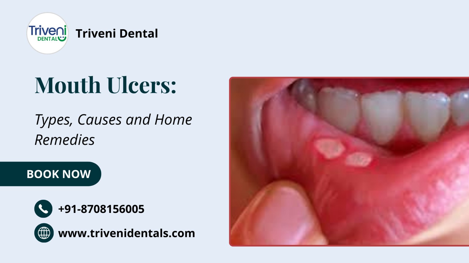 Understanding Mouth Ulcers: Types, Causes and Home Remedies
