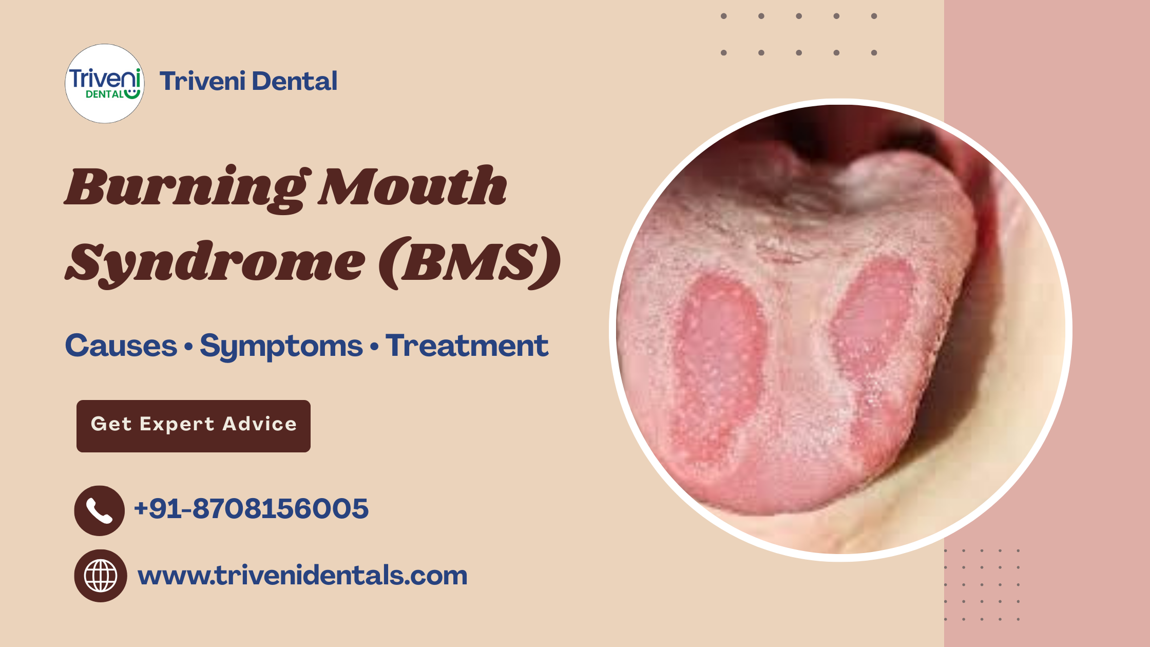 Why does my mouth burn? A complete guide to Burning Mouth Syndrome