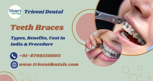 A Complete Guide to Teeth Braces Treatment in India