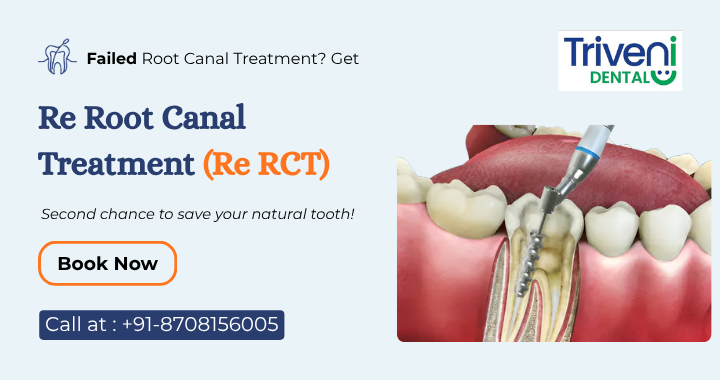 Failed Root Canal? Here’s how Re RCT can save your tooth